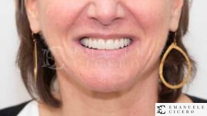 Full Mouth Reconstruction Benefits - English Speaking Dentist in Rome