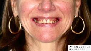 Full Mouth Reconstruction Benefits - English Speaking Dentist in Rome