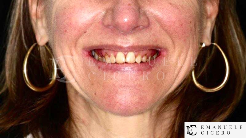 Full Mouth Reconstruction Benefits - English Speaking Dentist in Rome