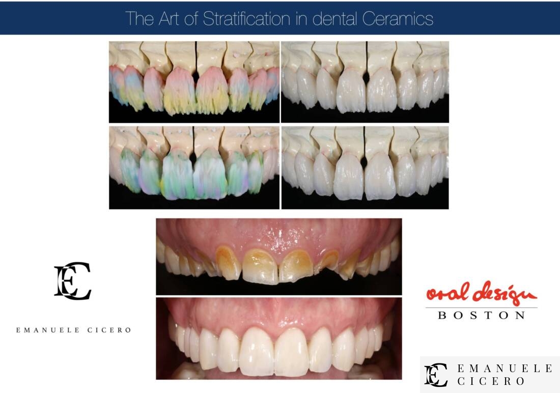 What are dental veneers: advantages, disadvantages, duration - Emanuele Cicero