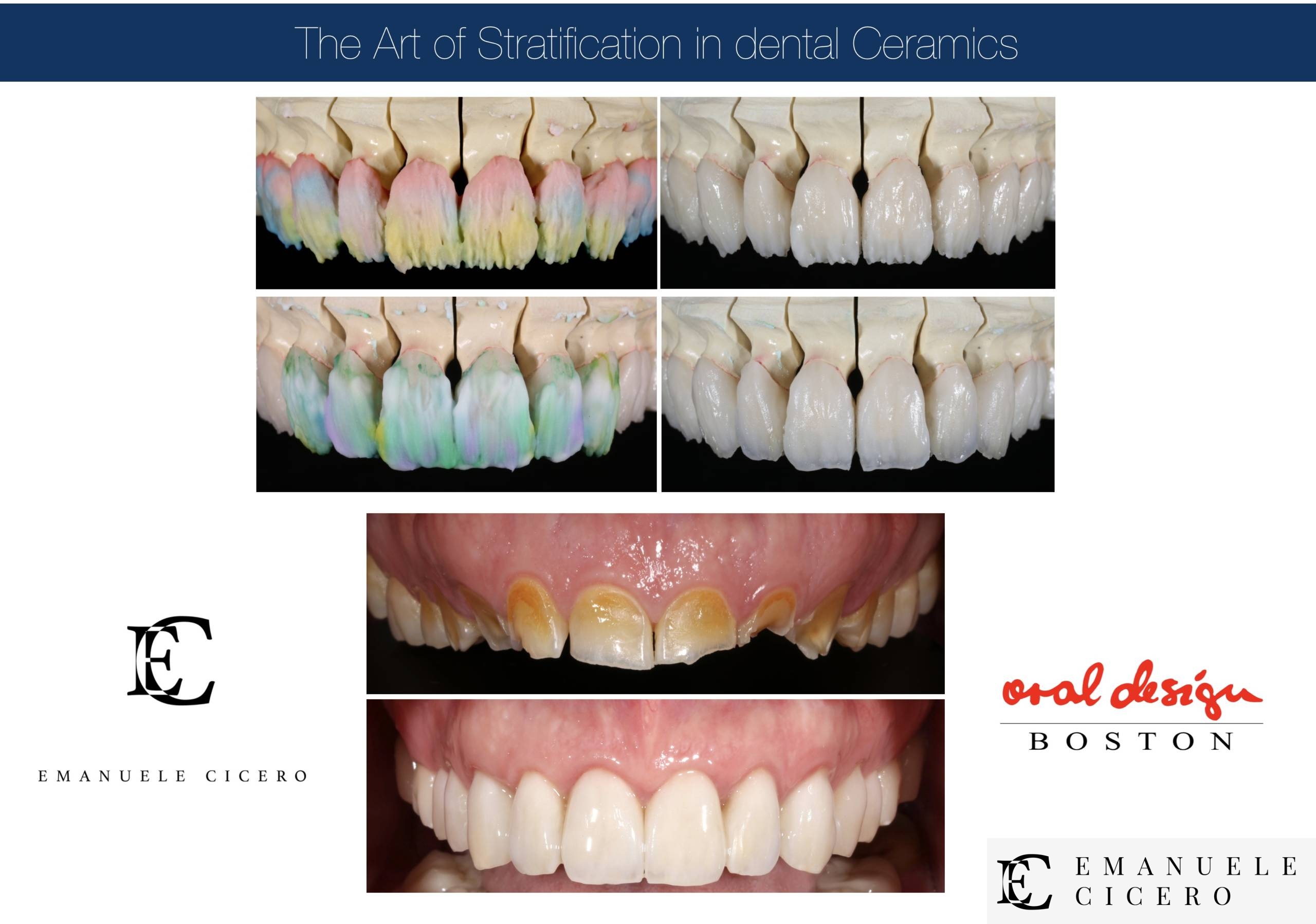 What are dental veneers  advantages disadvantages duration Emanuele 