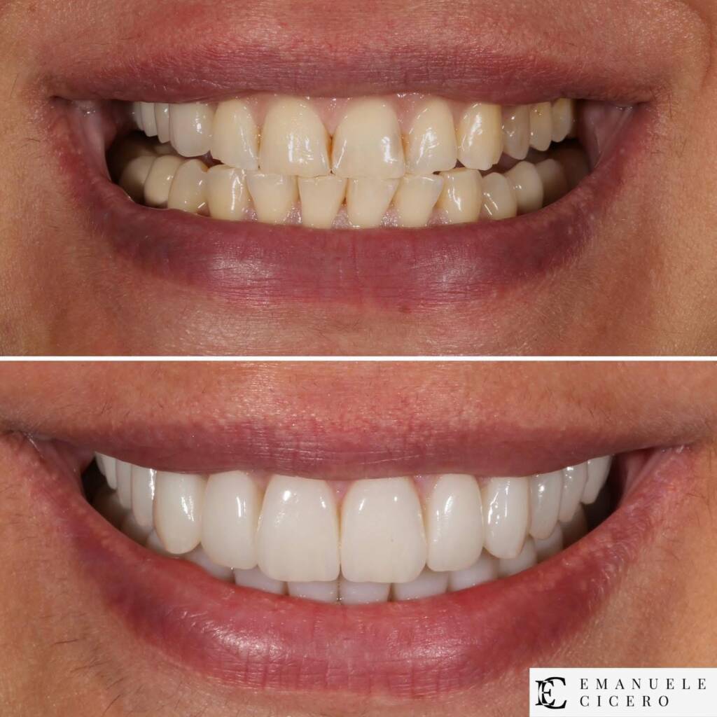 Costo faccette dentali