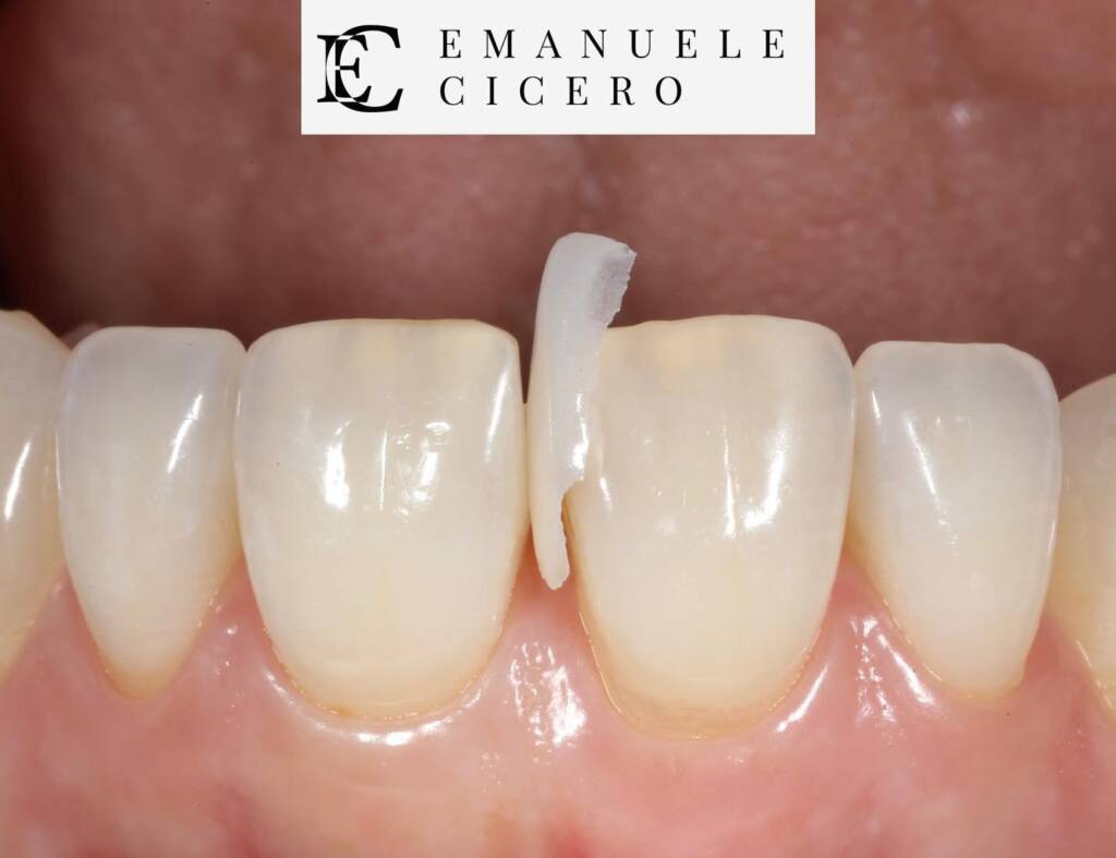 Consigli per le faccette dentali