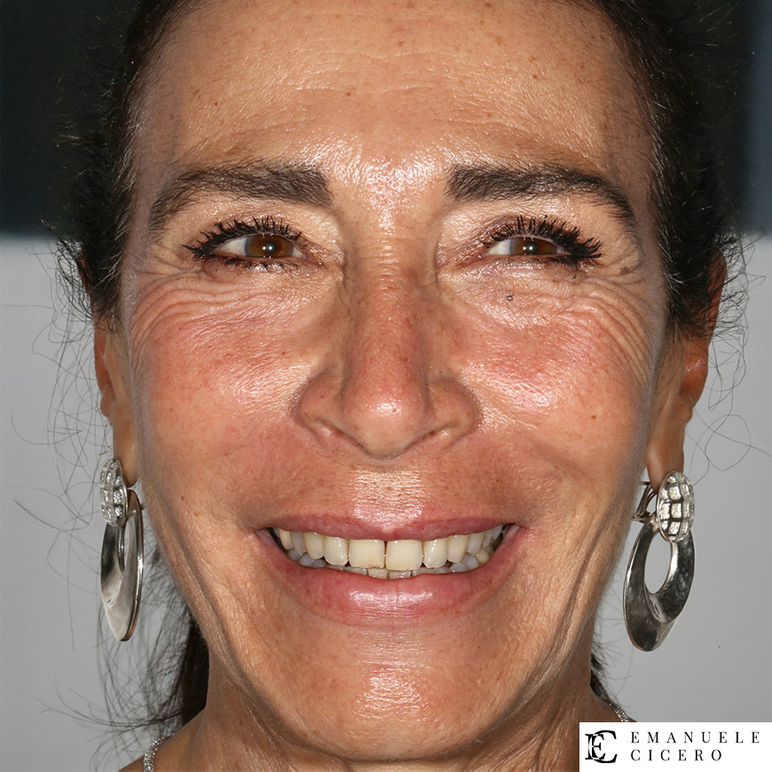 Faccette dentali: prima e dopo