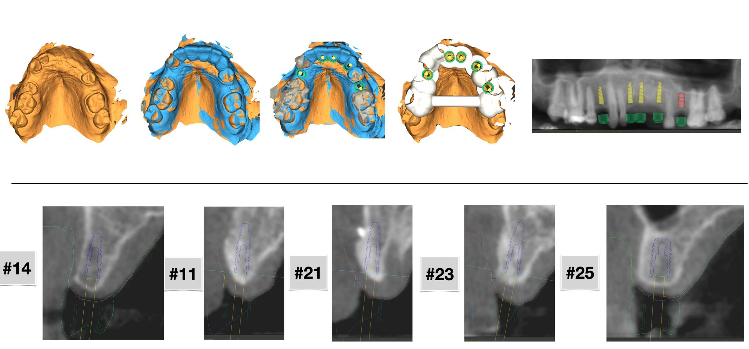 Posizionamento digitale degli impianti dentali