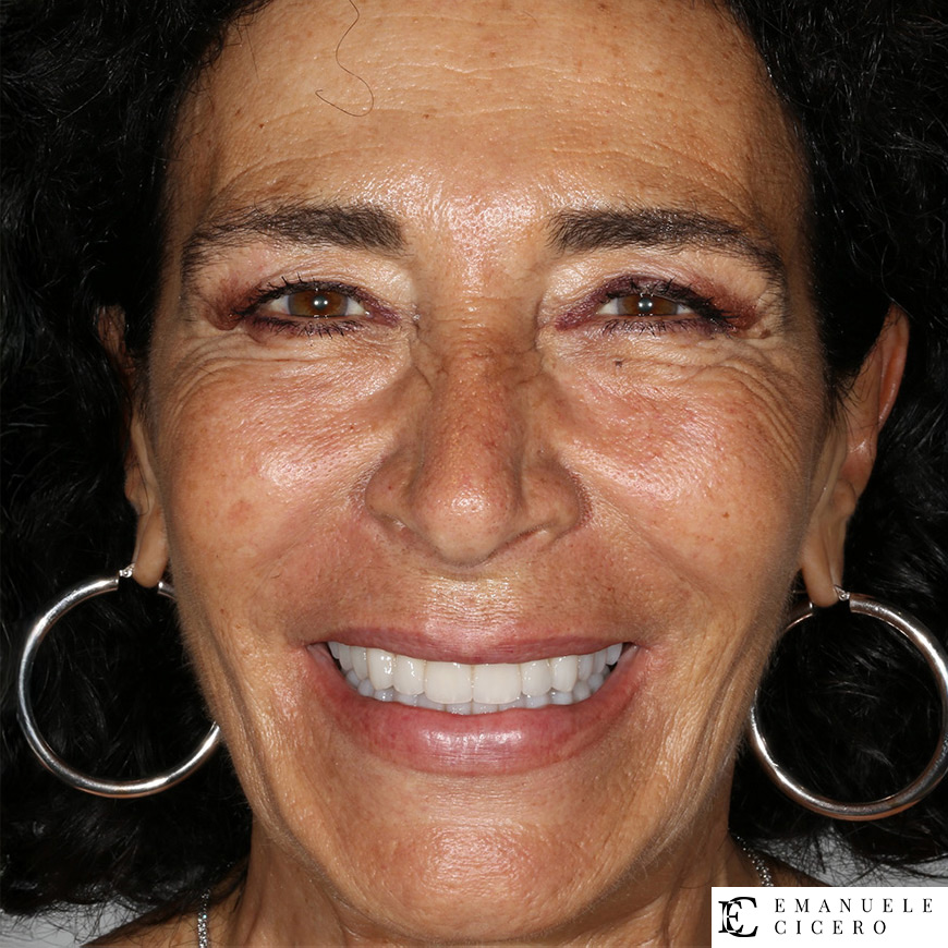 Faccette dentali: prima e dopo